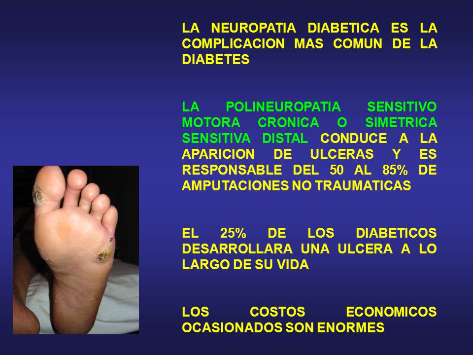 neuropatía más común en diabetes neuropatía más común en diabetes